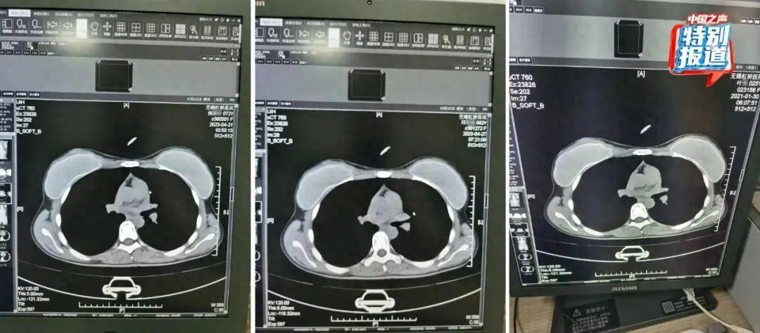 25岁、72岁、62岁三人CT片几乎一样？一医生实名举报无锡虹桥医院涉嫌骗保-新开棋牌(图1)